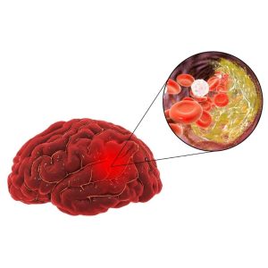 beyne pıhtı atması