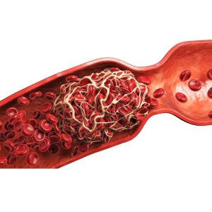 beyne pıhtı atması