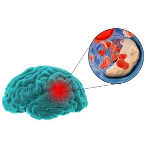 beyne pıhtı atması