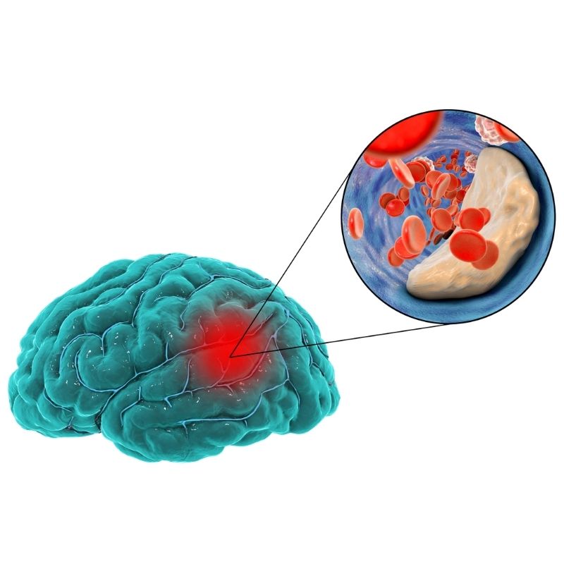 beyne pıhtı atması