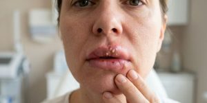 dudak dolgusu sonrası enfeksiyon belirtileri