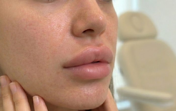 Dudak Dolgusu Sonrası Ödem