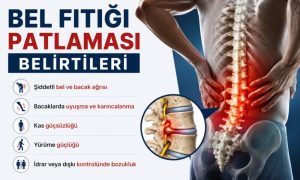 Bel Fıtığı Patlaması Belirtileri